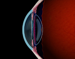 Presbyopia